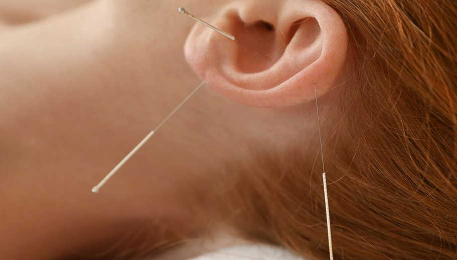 ear acupuncture