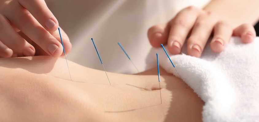 acupuncture